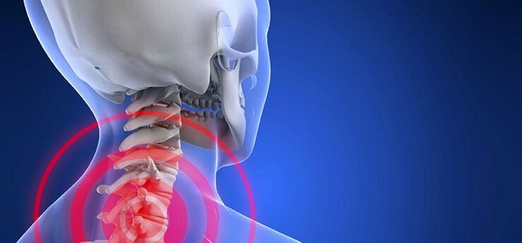 Gimdos kaklelio regiono osteochondrozė