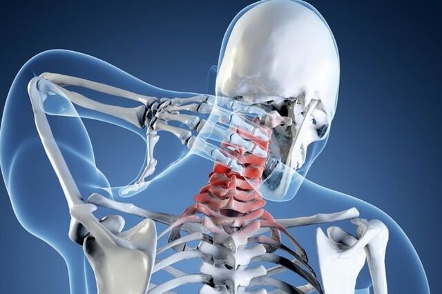 Gimdos kaklelio regiono osteochondrozė