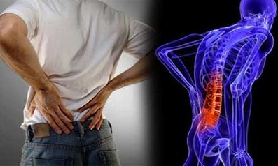 Juosmens osteochondrozės vystymosi priežastys