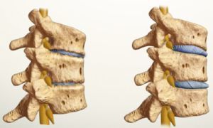 kaip atrodo osteochondrozė