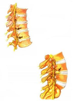 stuburo osteochondrozės iliustracija