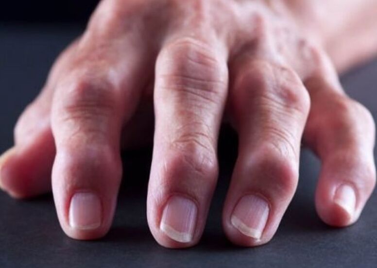 reumatoidinis artritas kaip pirštų sąnarių skausmo priežastis