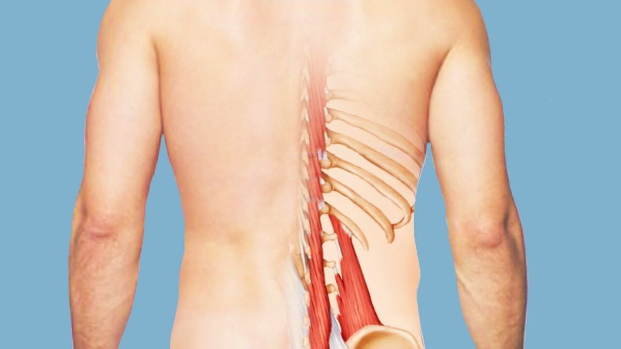 miozitas kaip nugaros skausmo priežastis